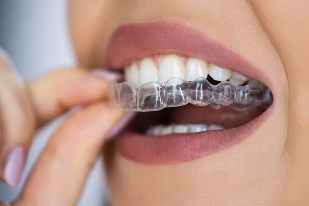 Invisalign / Invisible Braces